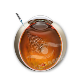 黃斑病變-注射生長(zhǎng)因子.png